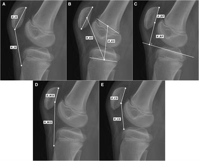 Reliability and modality analysis of patellar height measurement in pediatric knee